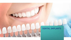 Smile Design Dental Spa - All On Four Dental Implants by Smile Design Dental Spa