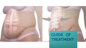Smartlipo Los Angeles By Liposuction Centers by Los Angeles Liposuction Centers